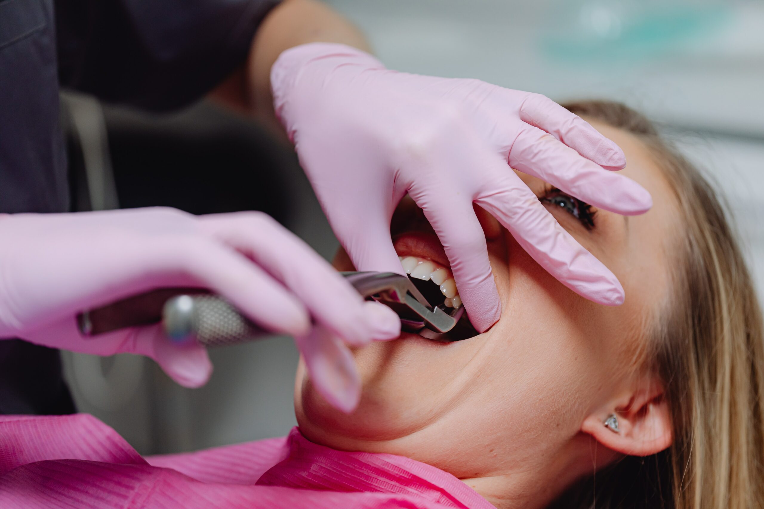 Cuidados após extração dentária