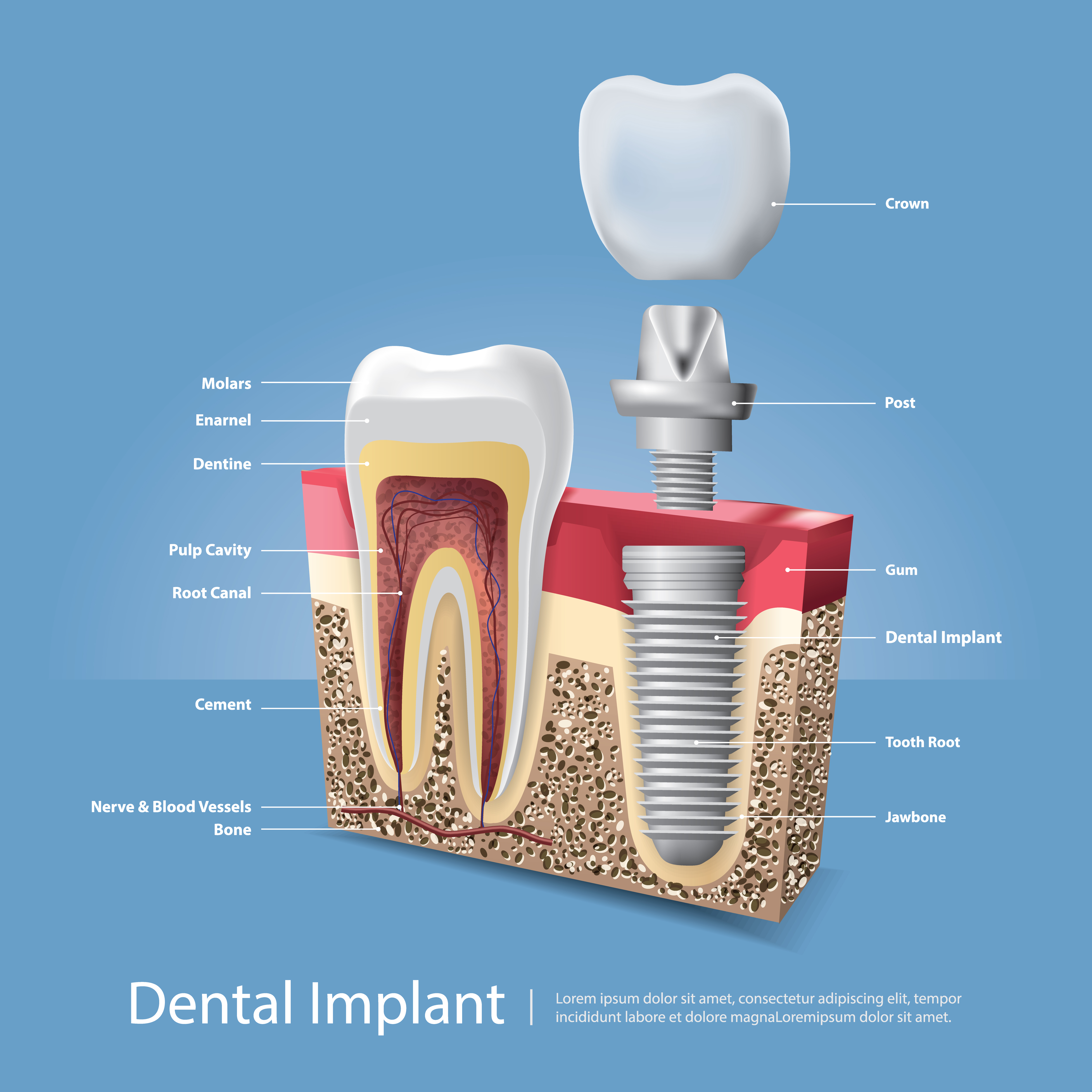 Implantes dentários: tudo que você precisa saber